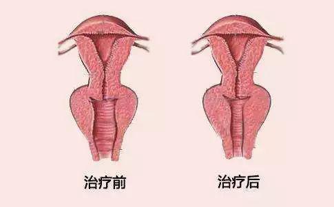 陰道緊縮手術怎麽做