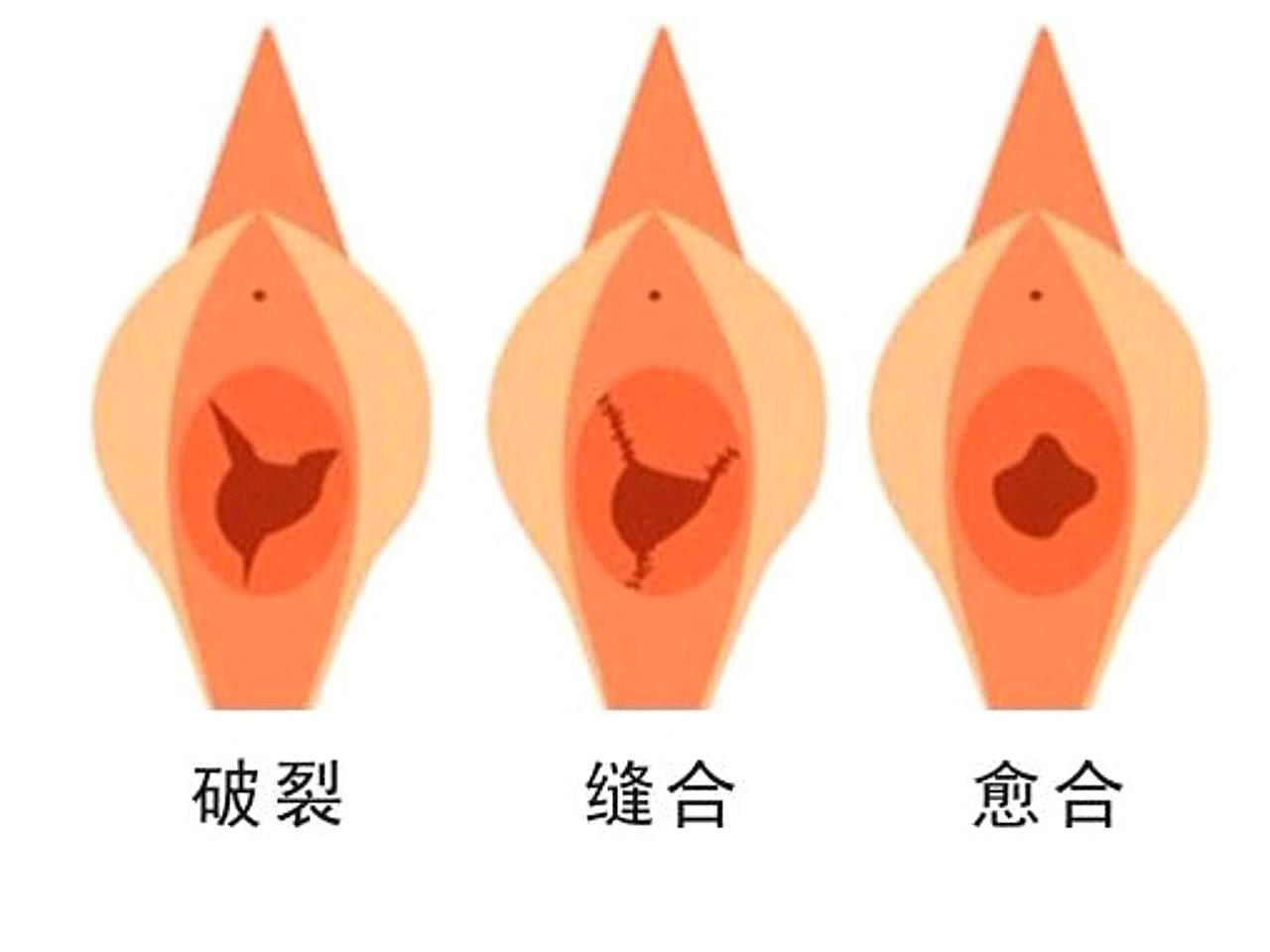 處女膜修復多少錢