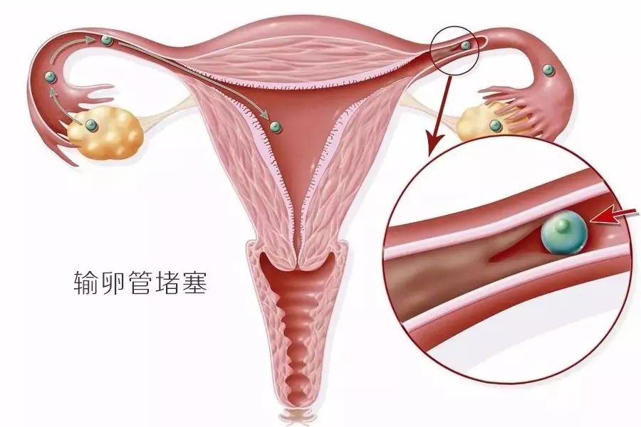 輸卵管堵塞的徵兆