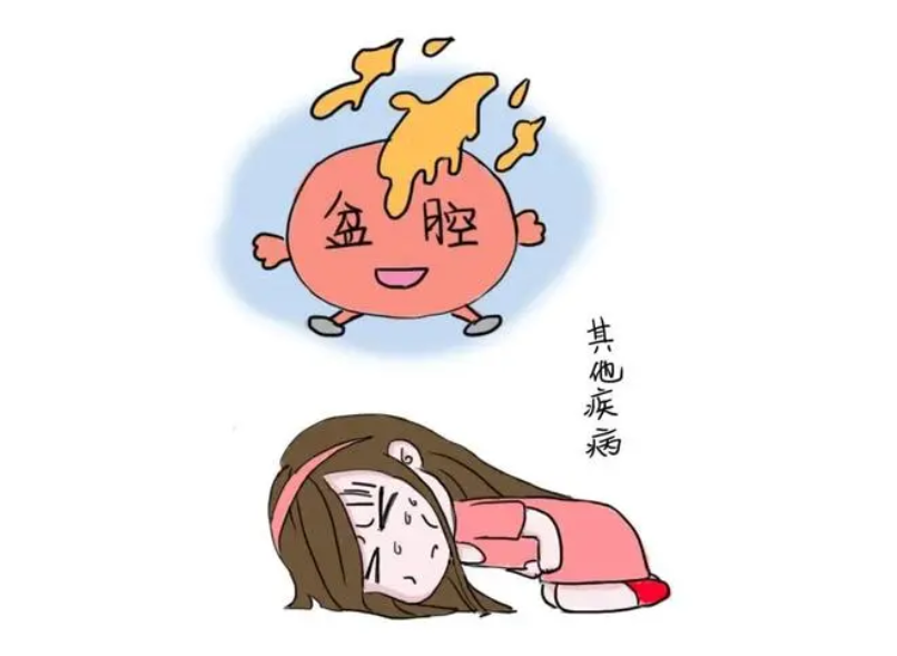 盆腔炎的主要病因是什麽