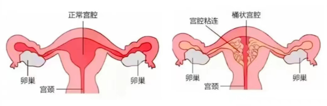 人工流產手術有什麼風險:人工流產後會出血幾天