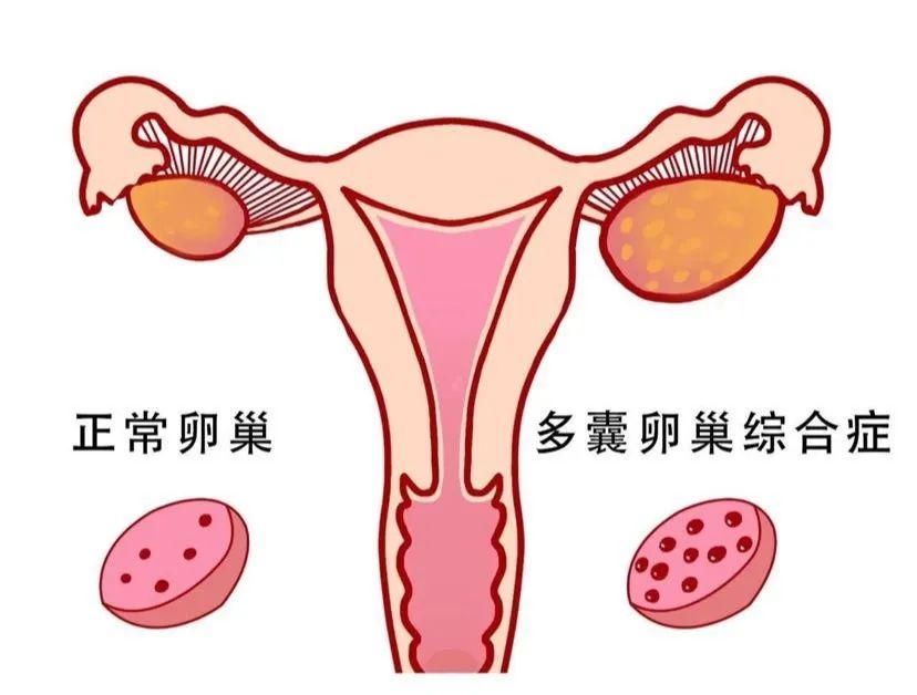 多囊卵巢症候群如何影響女性排卵功能？